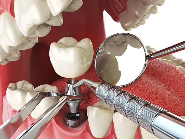 Best Emergency Root Canal Treatment in Lacoste, TX